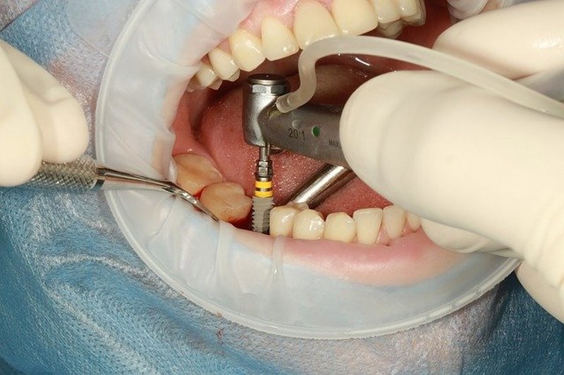 استیل 410 در تجهیزات دندانپزشکی